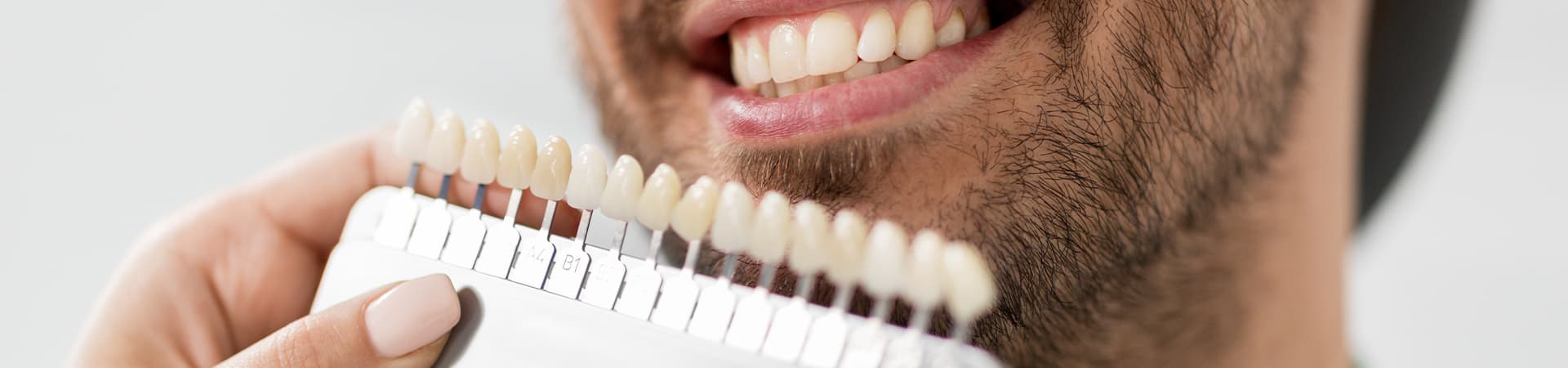 Veneers