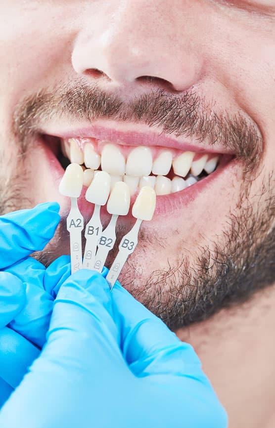 Veneers