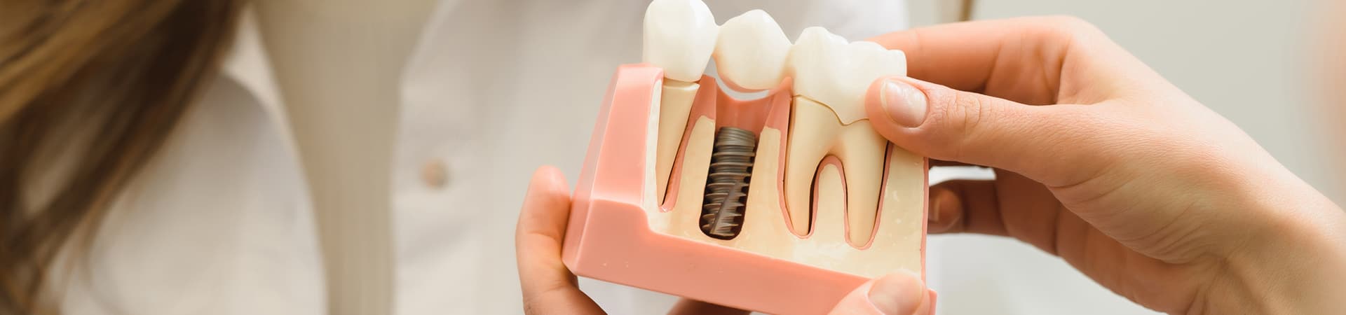 Dental Implants