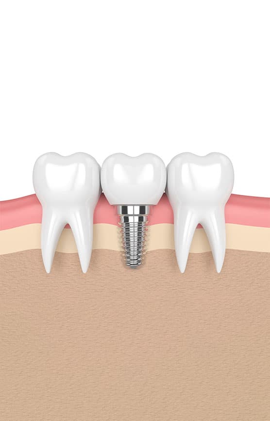 Dental Implants