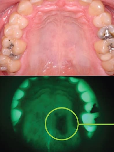 Enhanced Oral Cancer Assessment