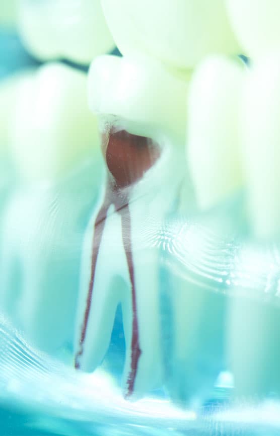 Root Canals