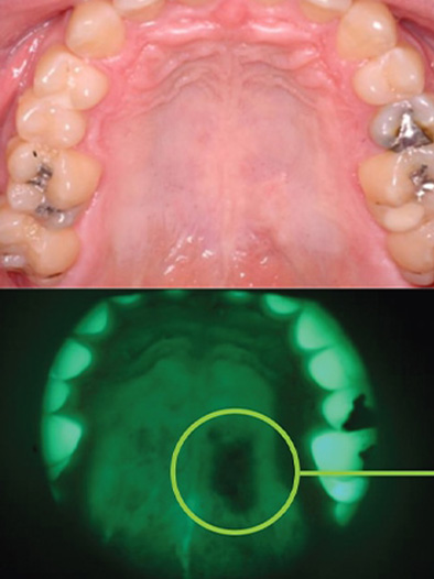 zenDental-Oral-Cancer-Assessment-supimg-June2023